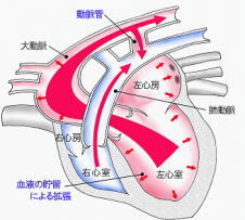 動脈管開存症の血液の流れ